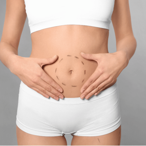 implantes faciales en Sabadell (3) operación estética de abdomen