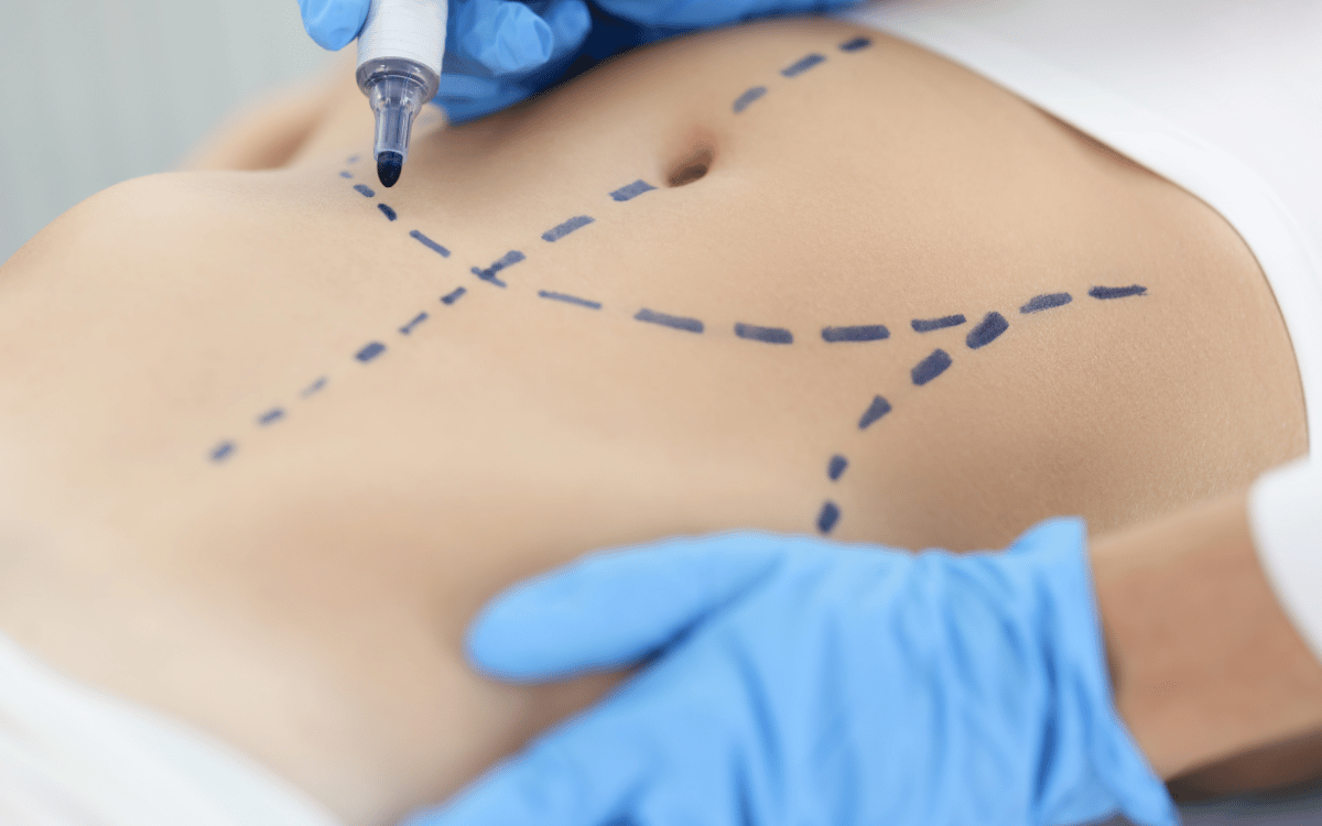 operación estética de abdomen
