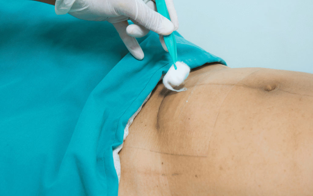 operación estética de abdomen