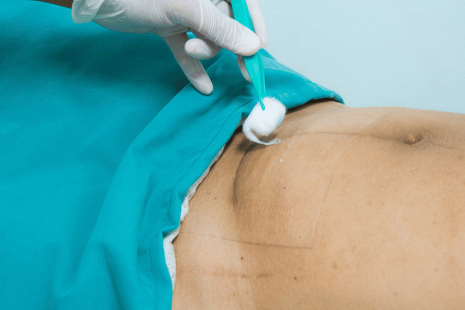 operación estética de abdomen