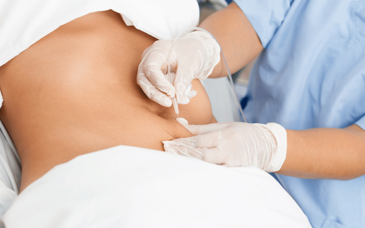 operación estética de abdomen