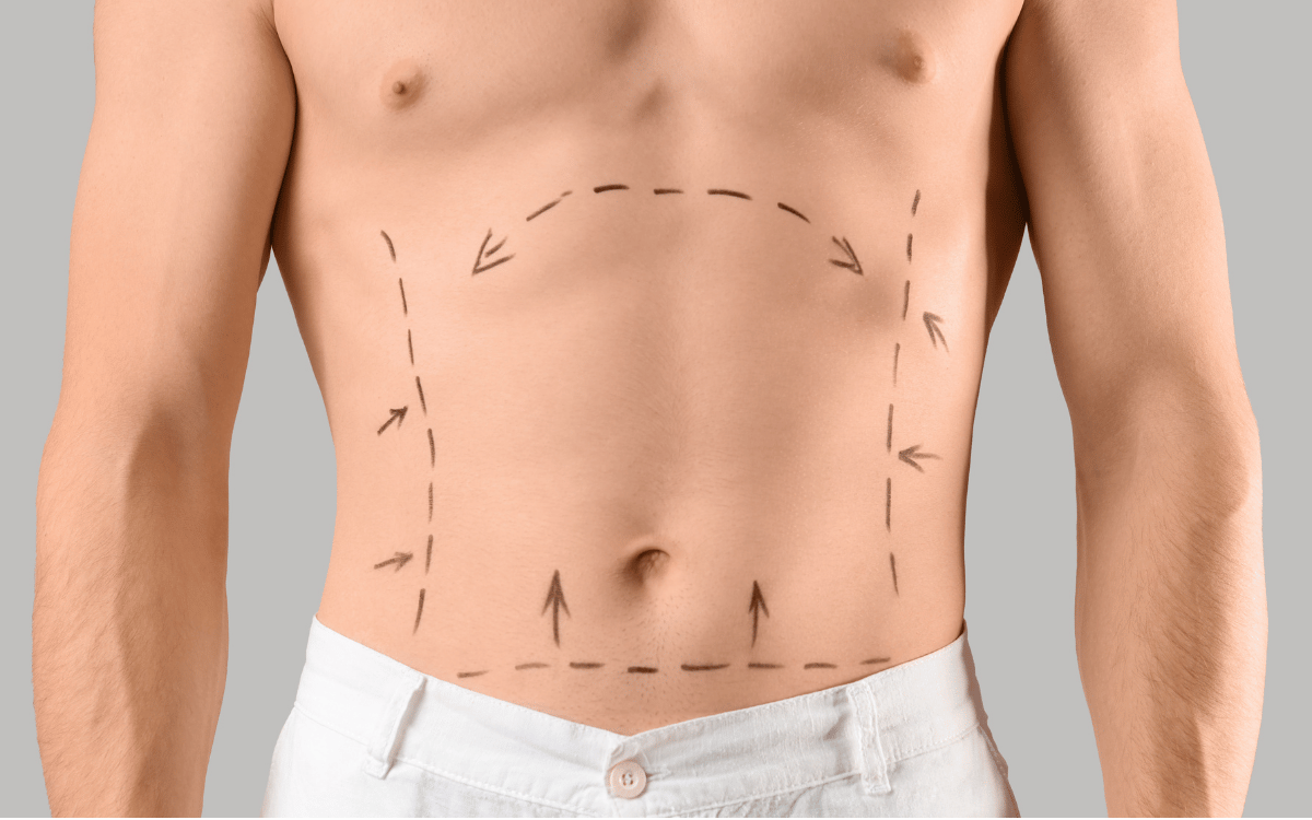 operación estética de barriga